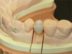 CAD/CAM冠に対応