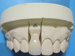 抜群の審美性と耐久性を誇るセラミックスの歯科技工物