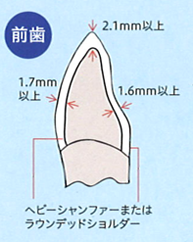 ジルコニア　レイヤリング