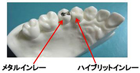 インレー比較模型