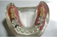 ［1］ファインデンチャーと保険の義歯の比較模型