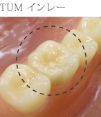 TUMインレー