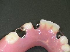 耐久性に優れた保険の義歯「熱可塑性義歯」